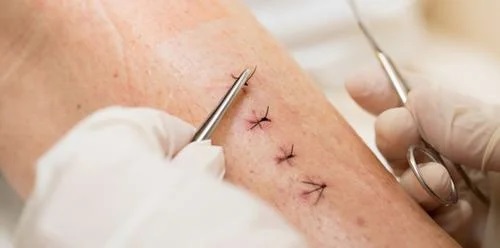 Tìm hiểu về cắt chỉ vết thương khâu – Trung Tâm y tế Yên Lạc