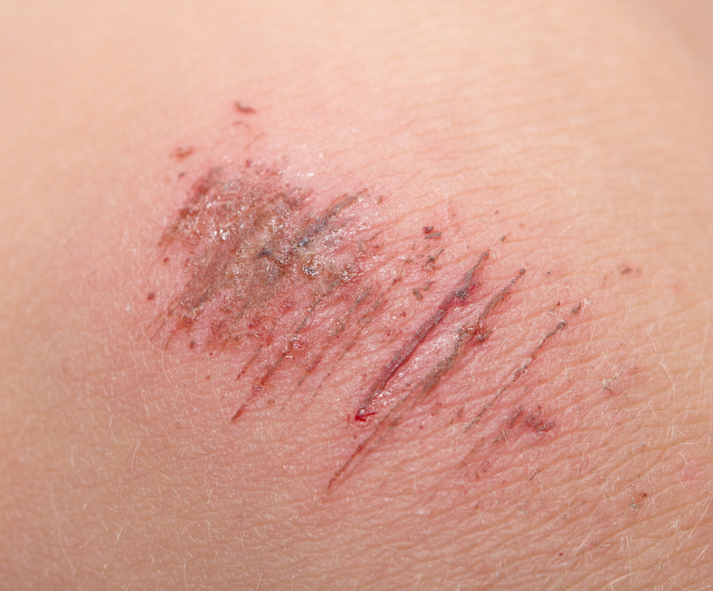 Không ai muốn chịu đựng vết thương trầy xước da, nhưng hãy cùng xem hình ảnh này để biết cách xử lý và chăm sóc để vết thương sớm lành và không để lại sẹo.